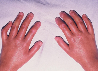 "硬皮病"是一种什么样的疾病?