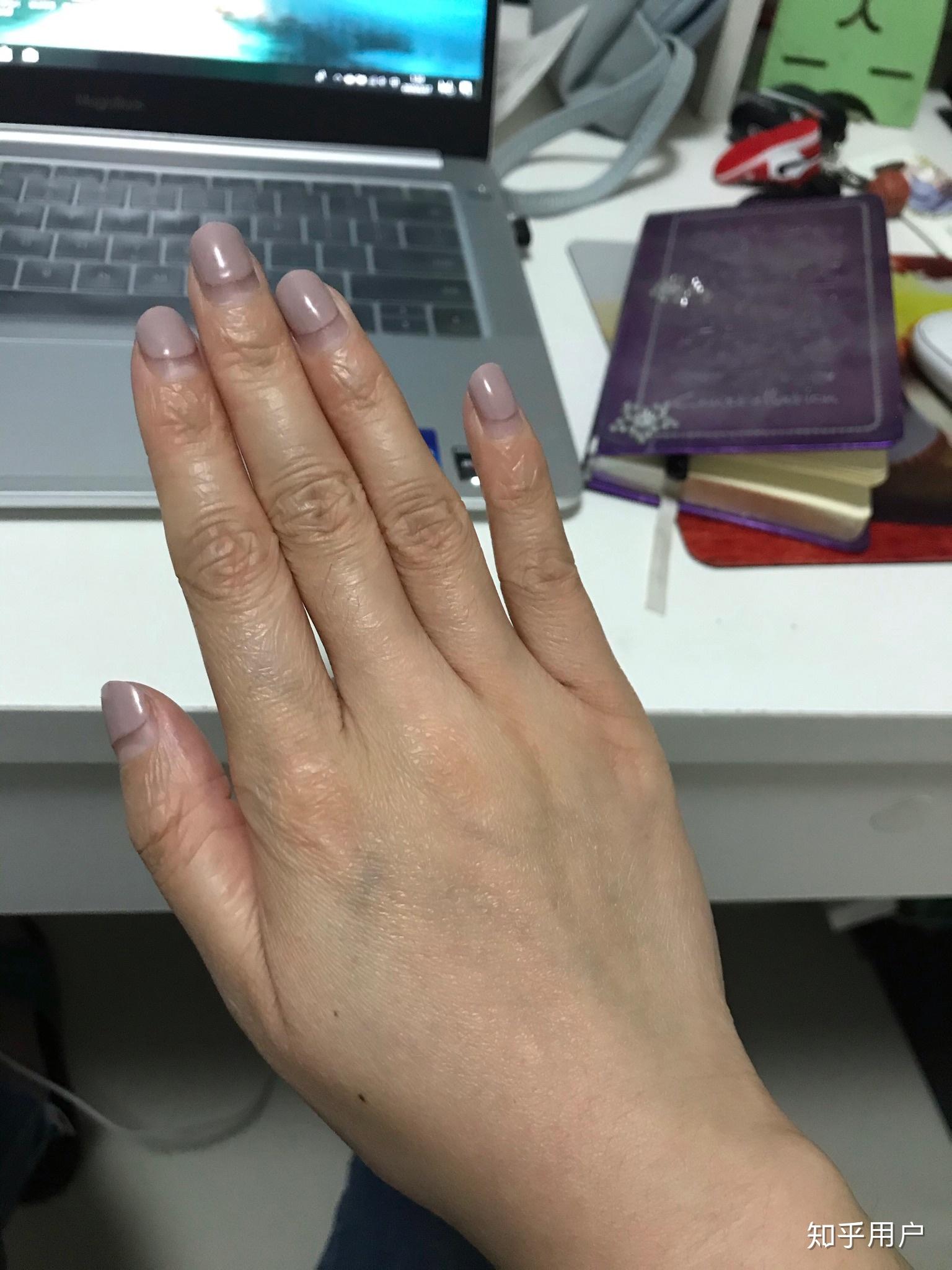 年纪轻轻23岁手上皮肤就很干有很多皱纹,像老年人干瘪的手,怎么办呀?