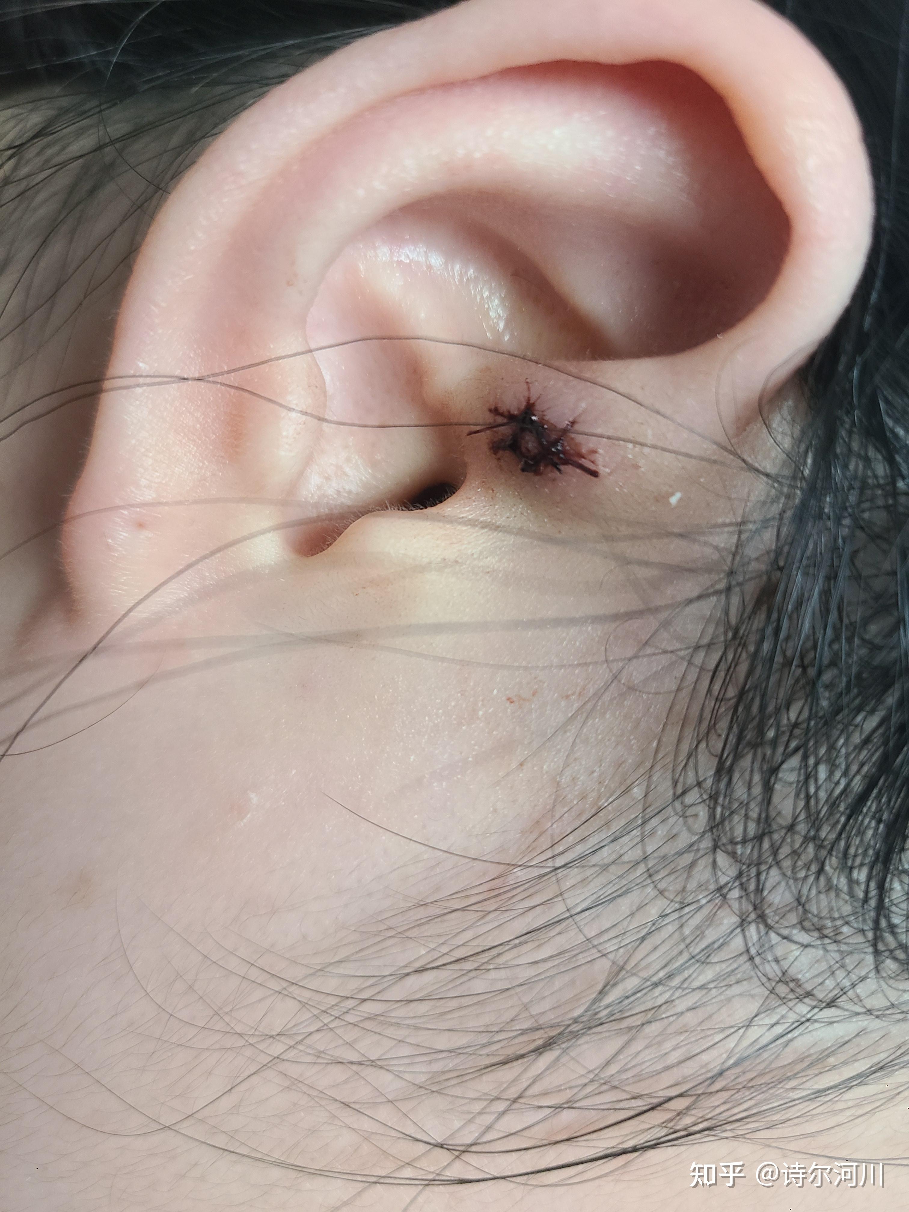 皮脂腺囊肿初期长啥样? - 知乎