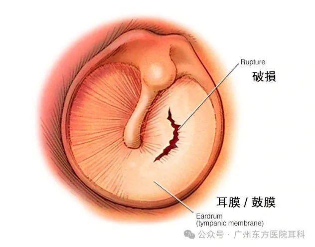 广州耳科专家解玉华告诉你耳膜破了到底要不要补