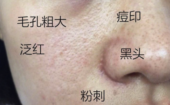 受损油敏皮如何修复? - 知乎