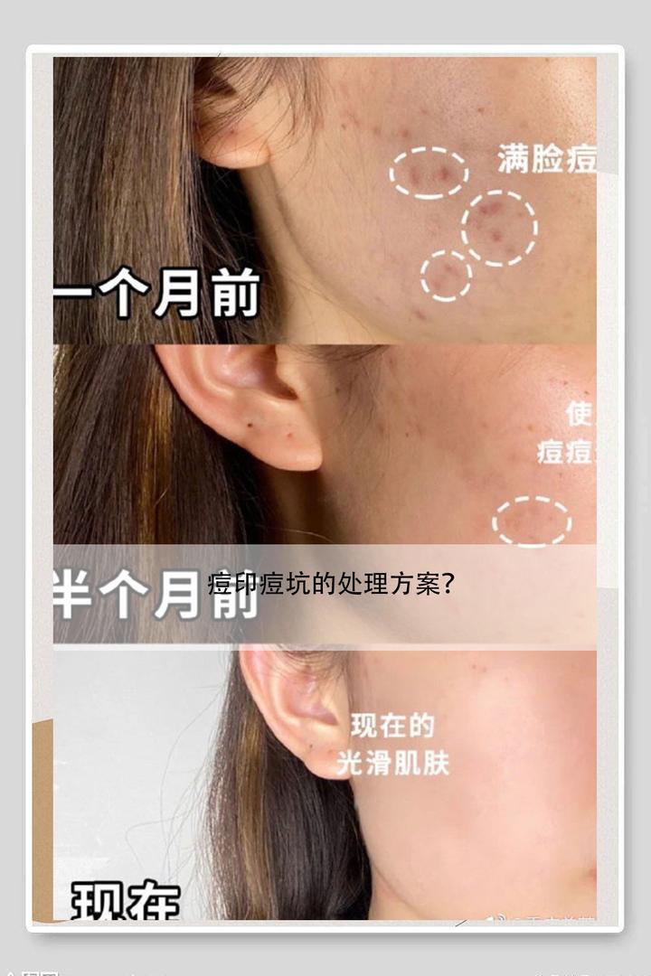 痘痘不可怕,痘印才可怕 - 知乎