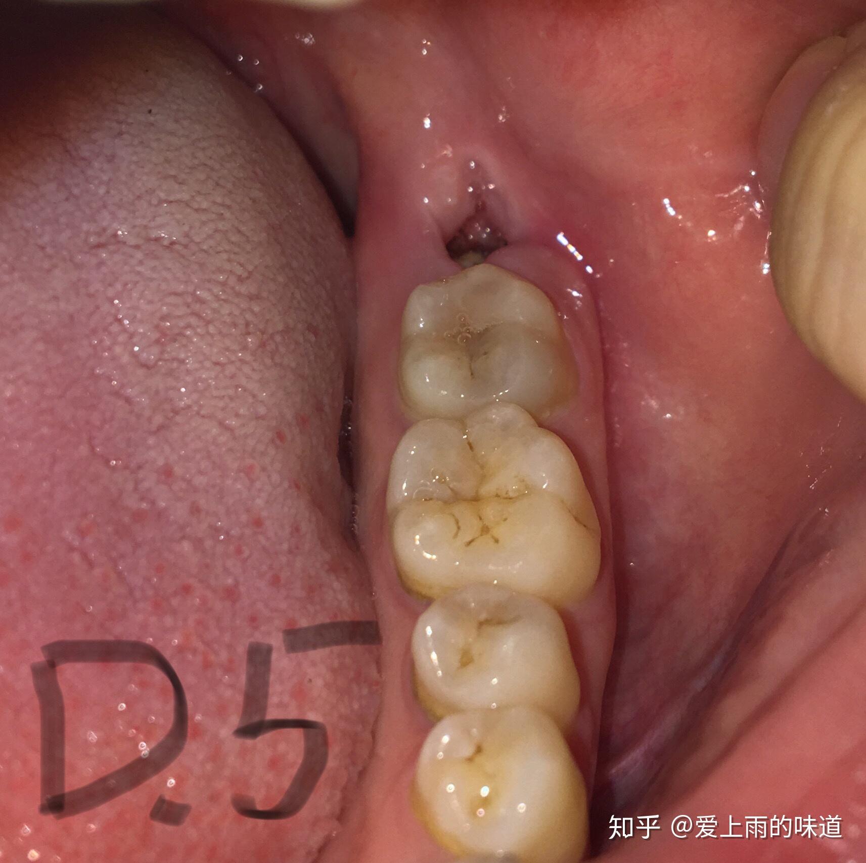 拔智齿后你吃什么愈合过程记录