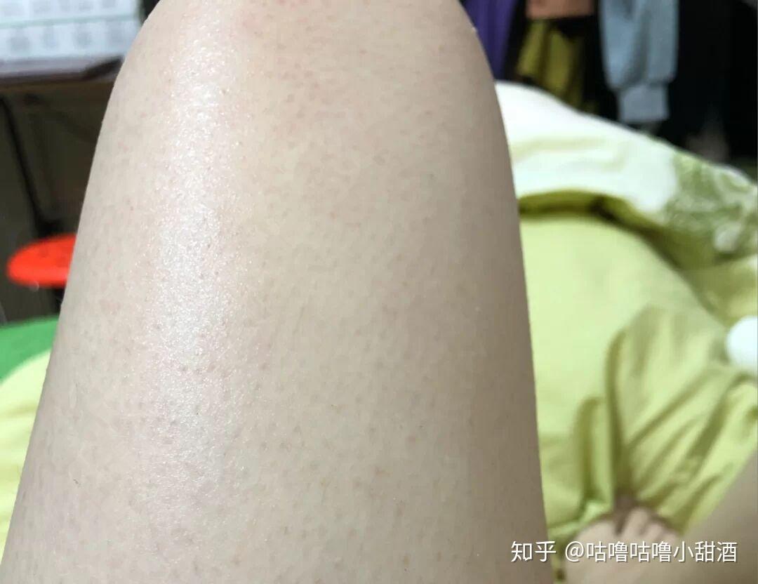 鸡皮肤但却很光滑(鸡皮肤但却很光滑是什么病)