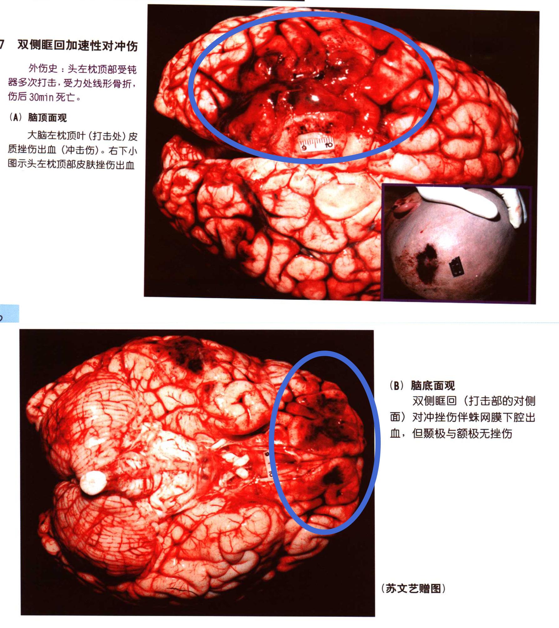人的脑袋剧烈晃动的时候脑子为什么不会变成一团浆糊
