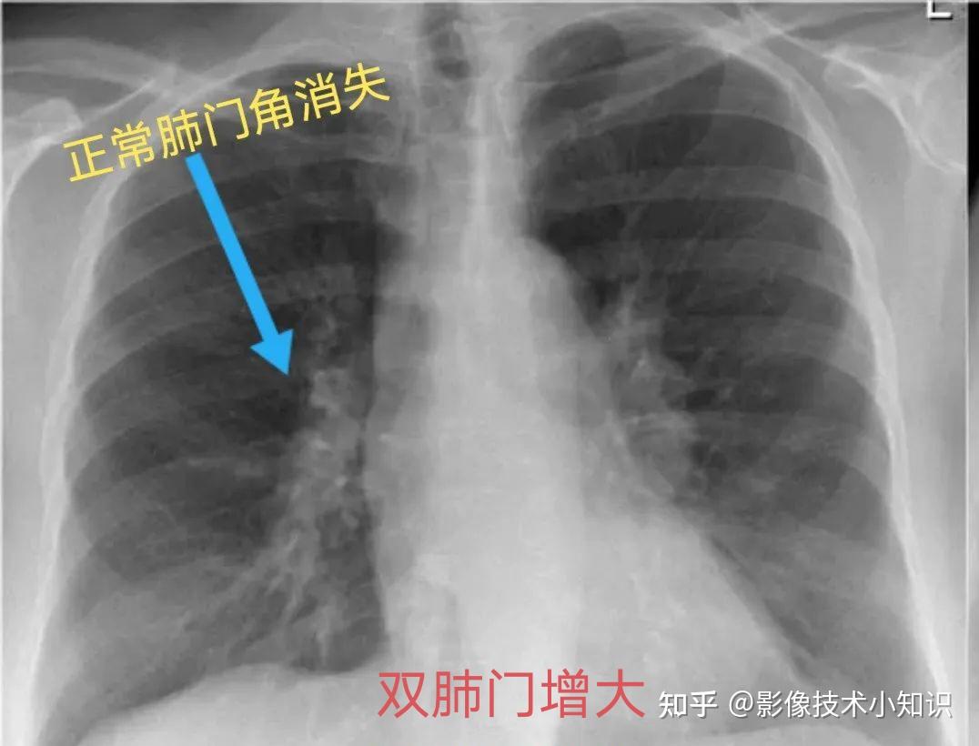 正常的肺门图片大全图片