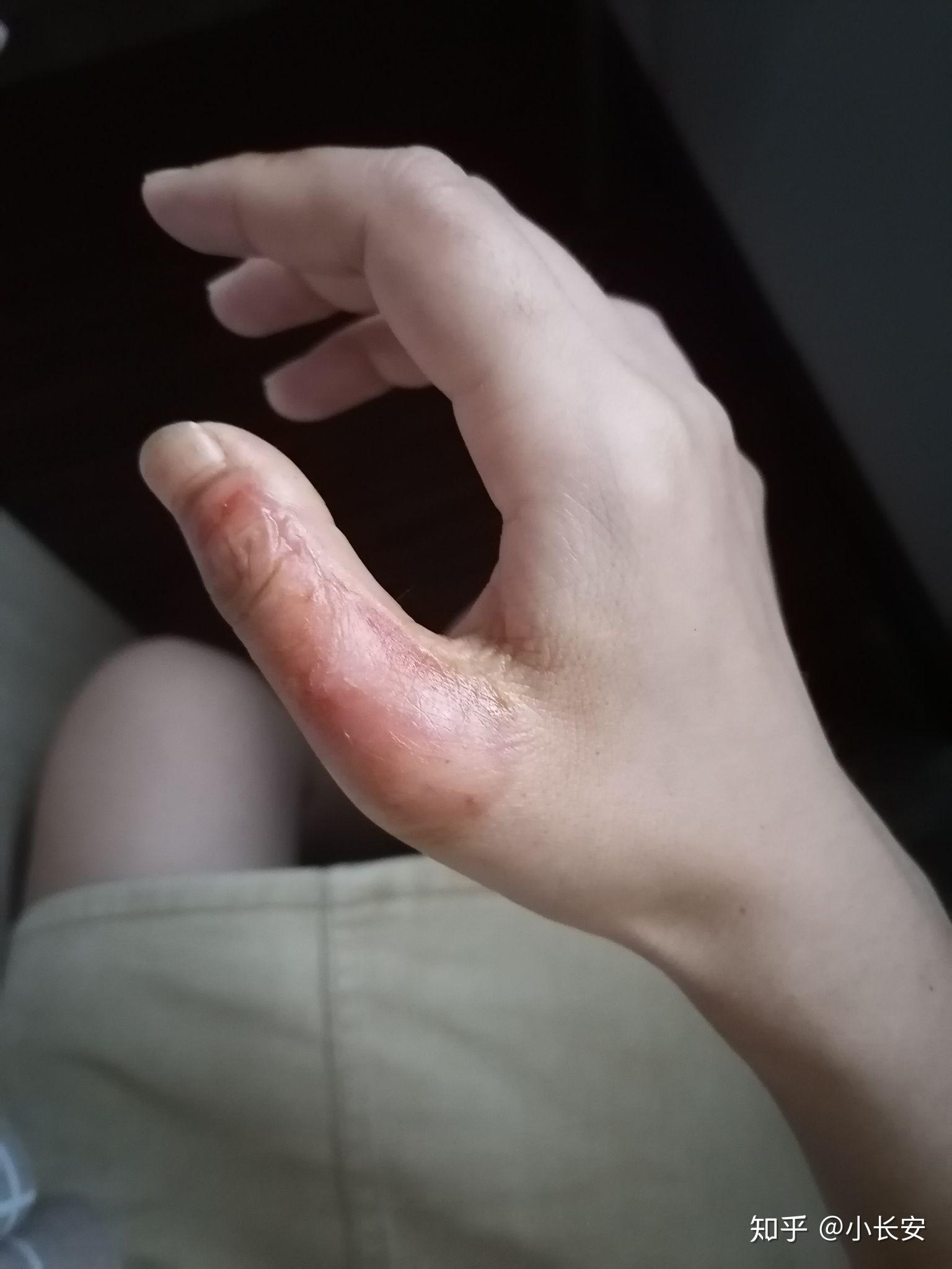 手背开水烫伤怎么恢复