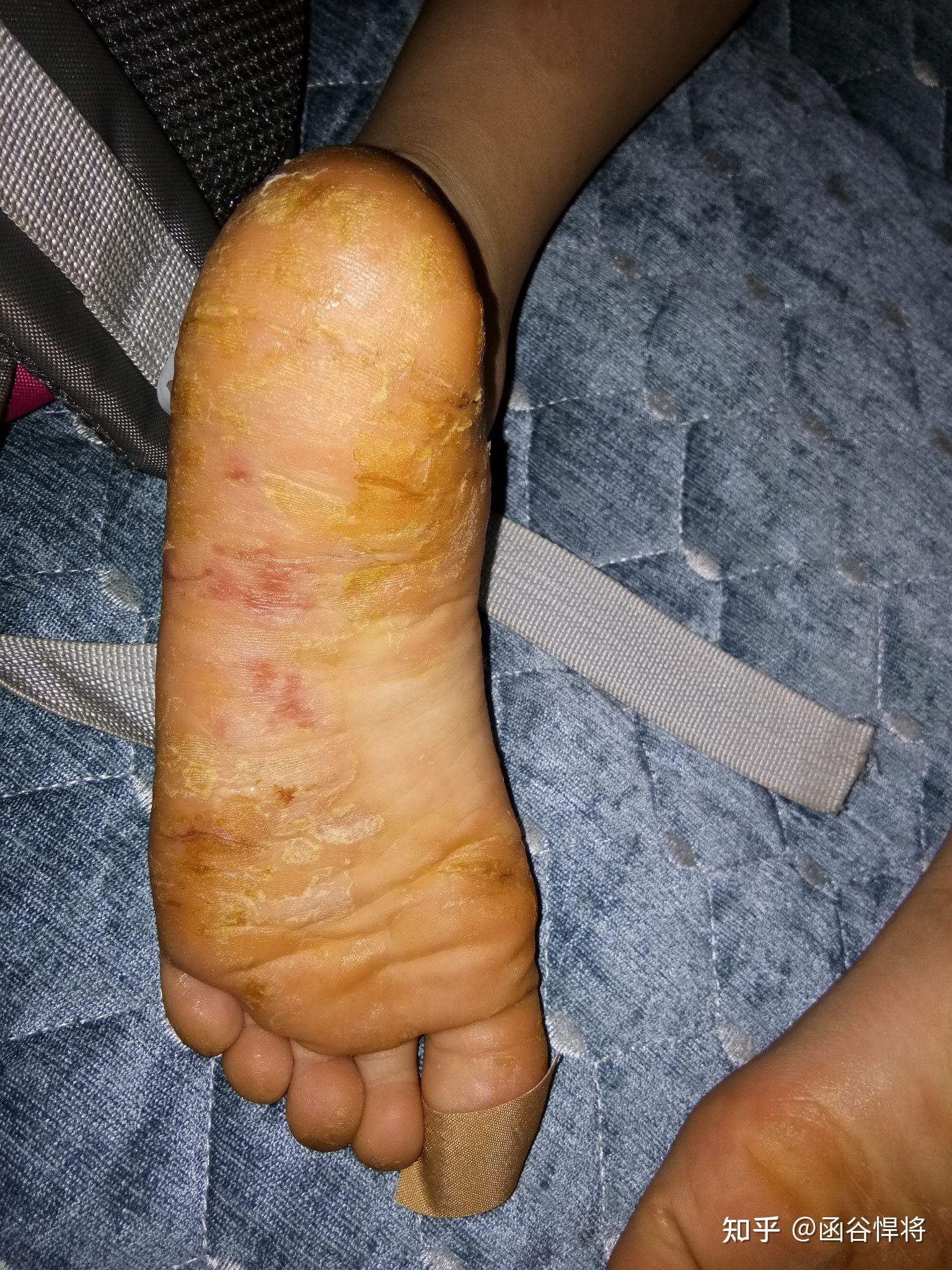脚后跟裂口是什么原因脚裂裂口子怎么回事