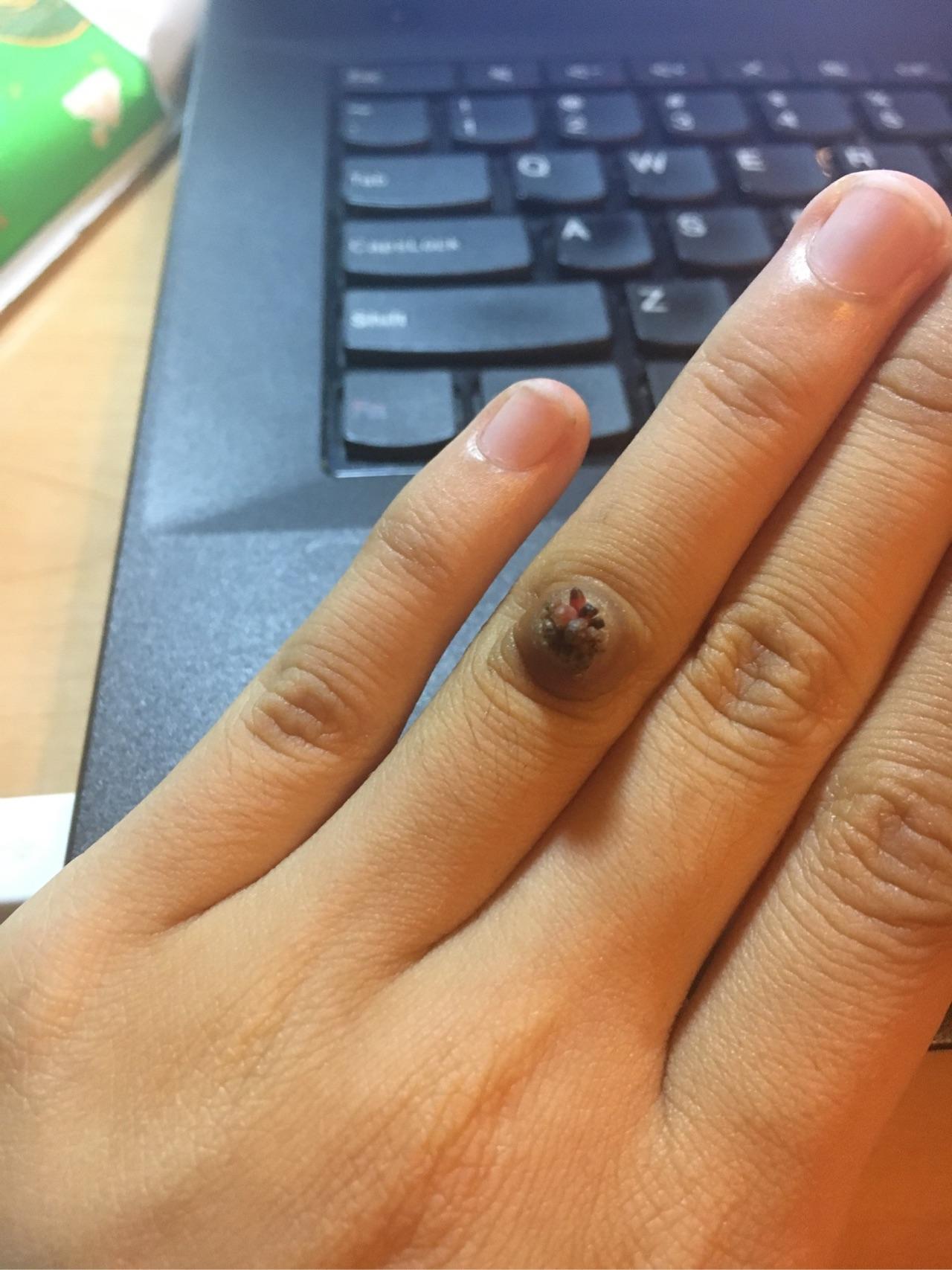 治疗手指上的寻常疣鱼鳞痣有什么办法或者药物