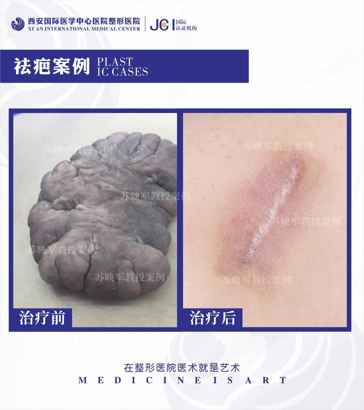 瘢痕疙瘩到底能不能做手术? - 知乎