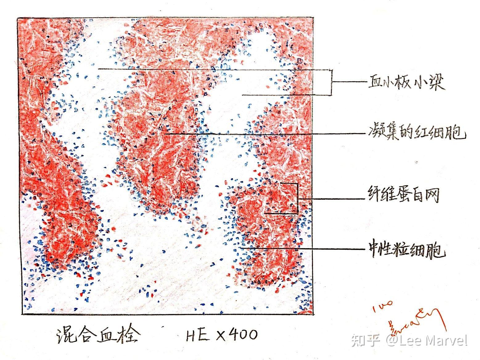 為什麼咱們不弄個病理紅藍手繪圖的問題呢