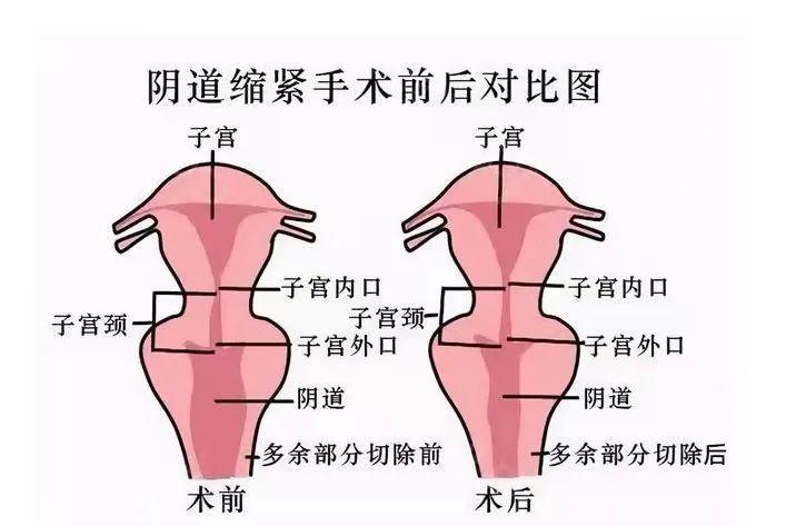 宫颈口松弛图片