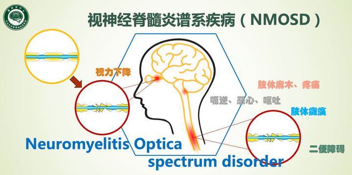 视神经脊髓炎谱系病.病友群 - 知乎
