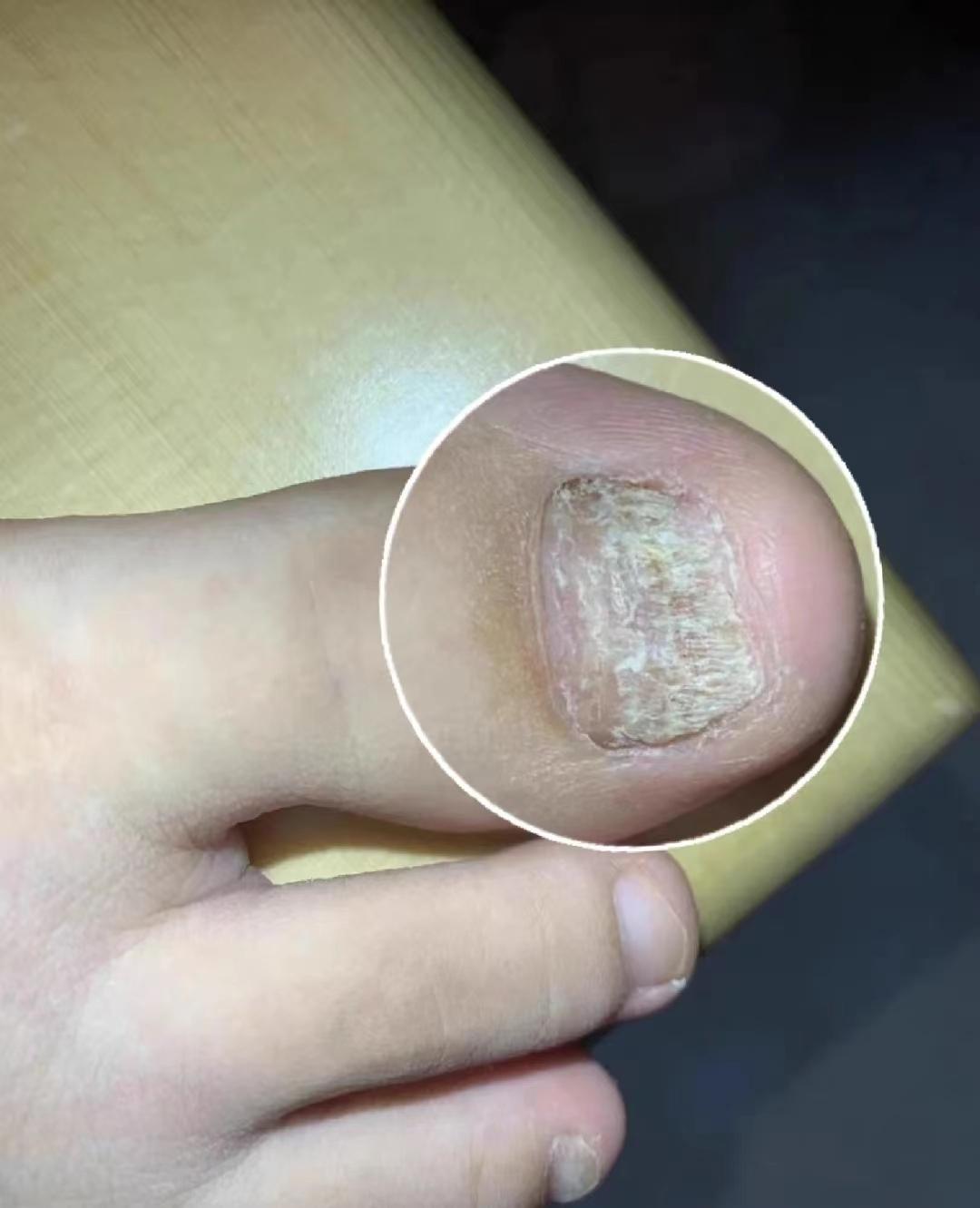 请问多个手指甲凹凸不平,甲床分离,增厚,变黄,是什么病,怎么治疗?