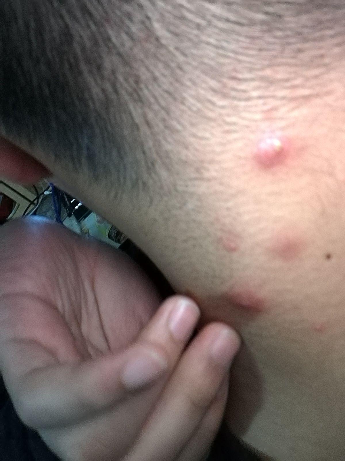 请问这是淋巴结核还是淋巴炎啊