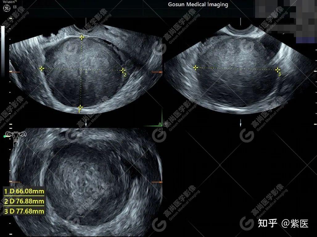 卵巢纤维瘤超声图片图片