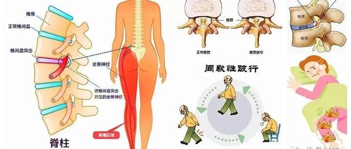 腰间盘突出怎么治疗最好的方法，看看这个就明白了 知乎