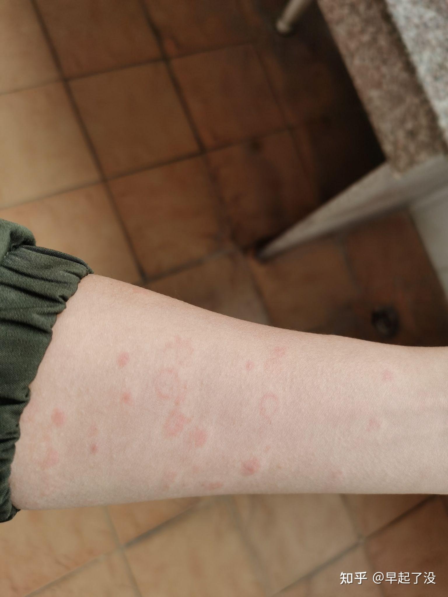 荨麻疹血管炎是很严重的病吗有得同样病的人吗