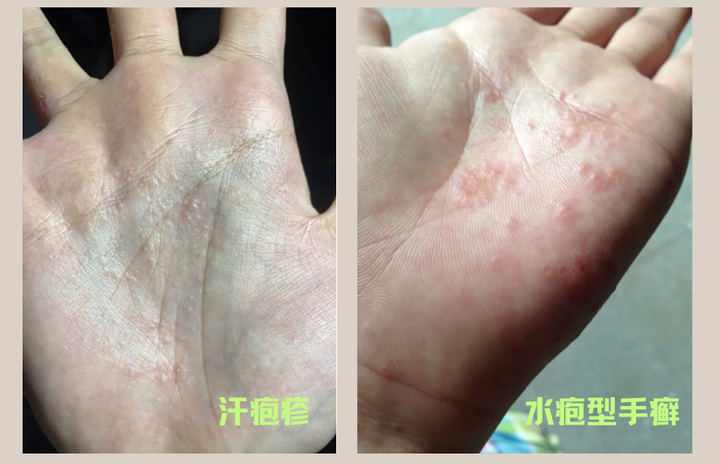 【科普】水疱型手癣和汗疱疹 - 知乎
