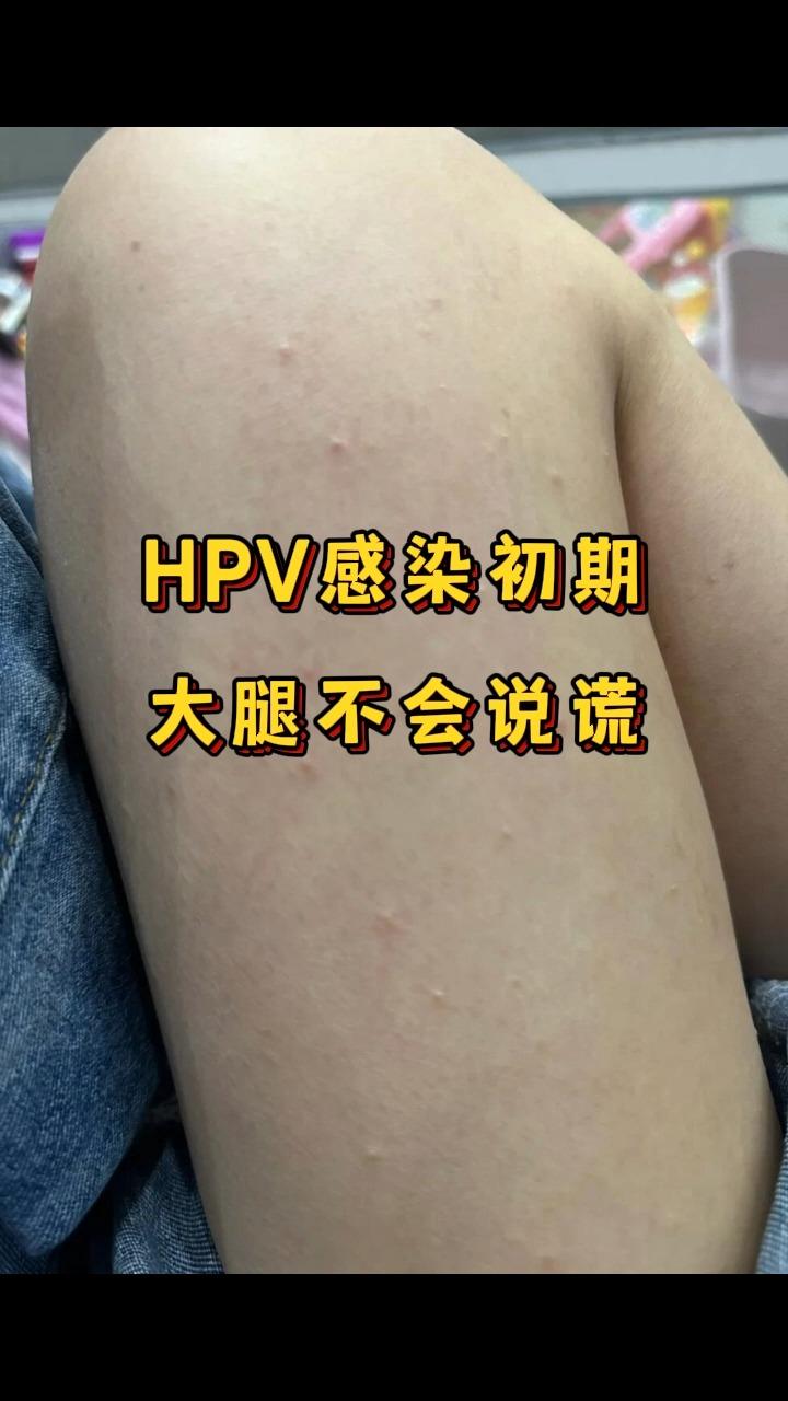 hpv感染初期,大腿不会说谎