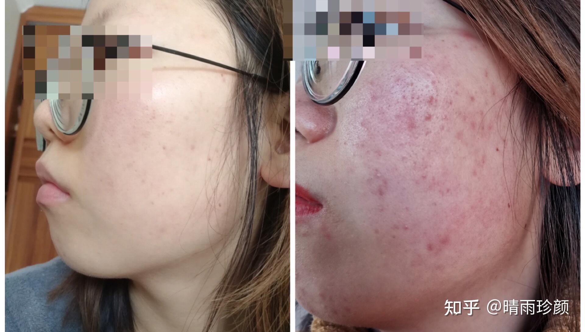 如何去掉脸上大面积的红色痘印？ - 知乎