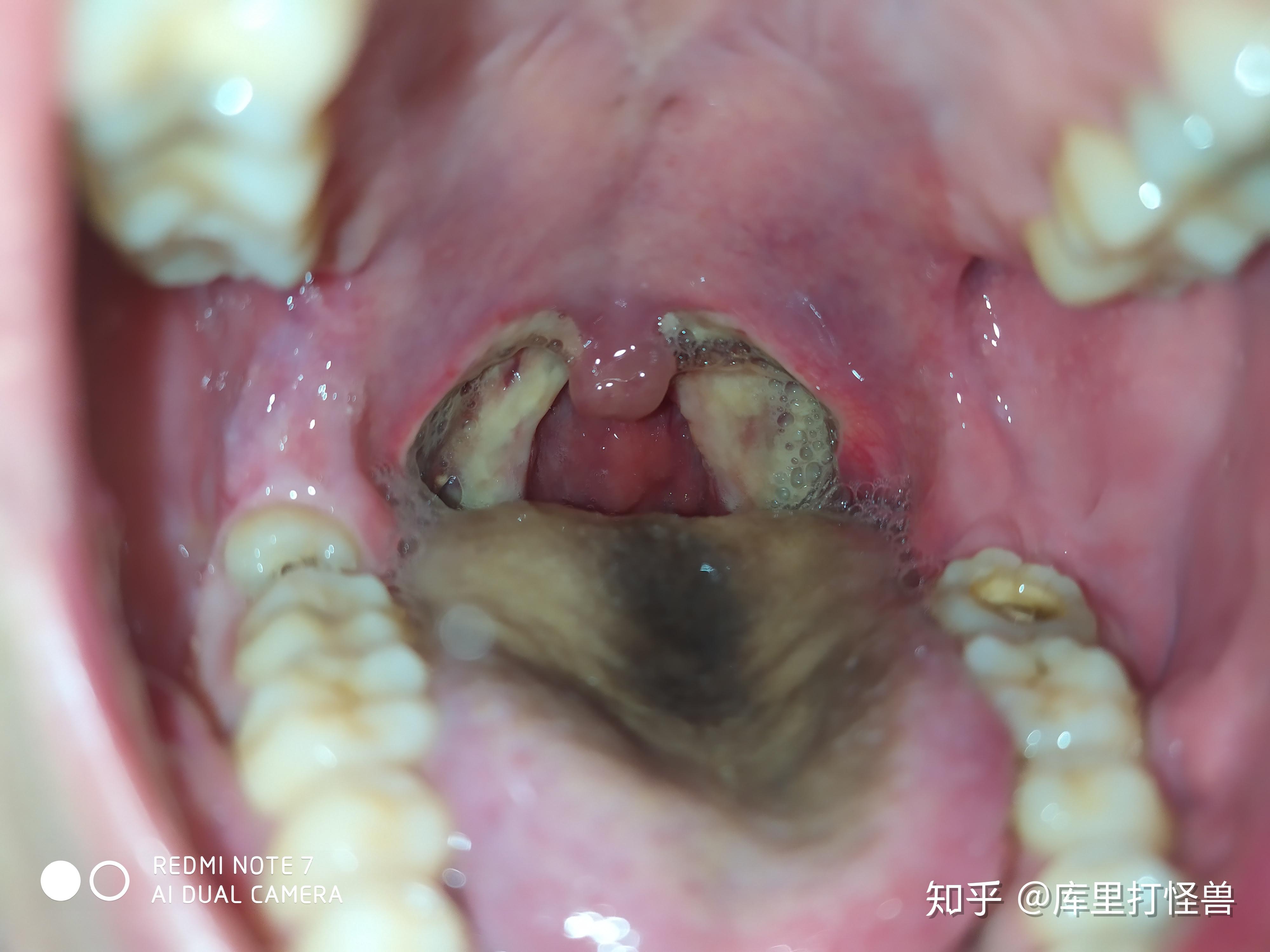 切扁桃体之后是什么感觉