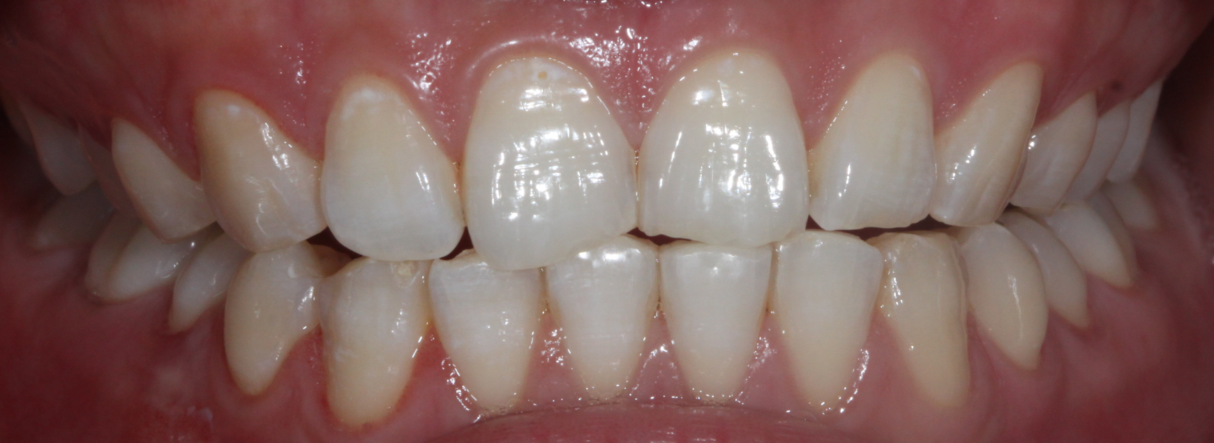 有什么方法可以让牙齿变白