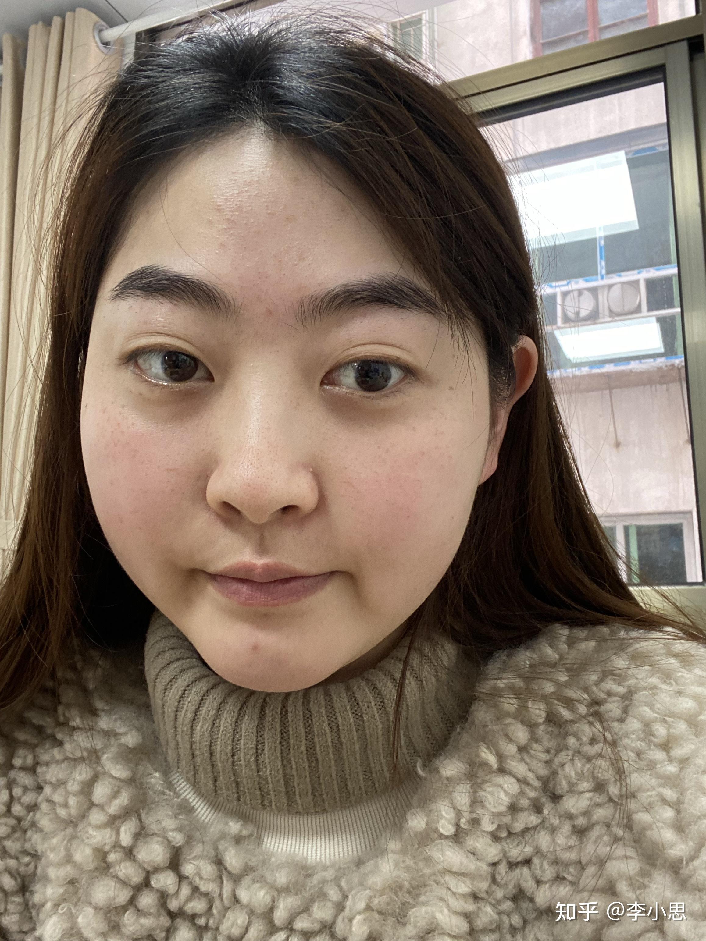 吃糖皮质激素引起的满月脸可以完全恢复吗?