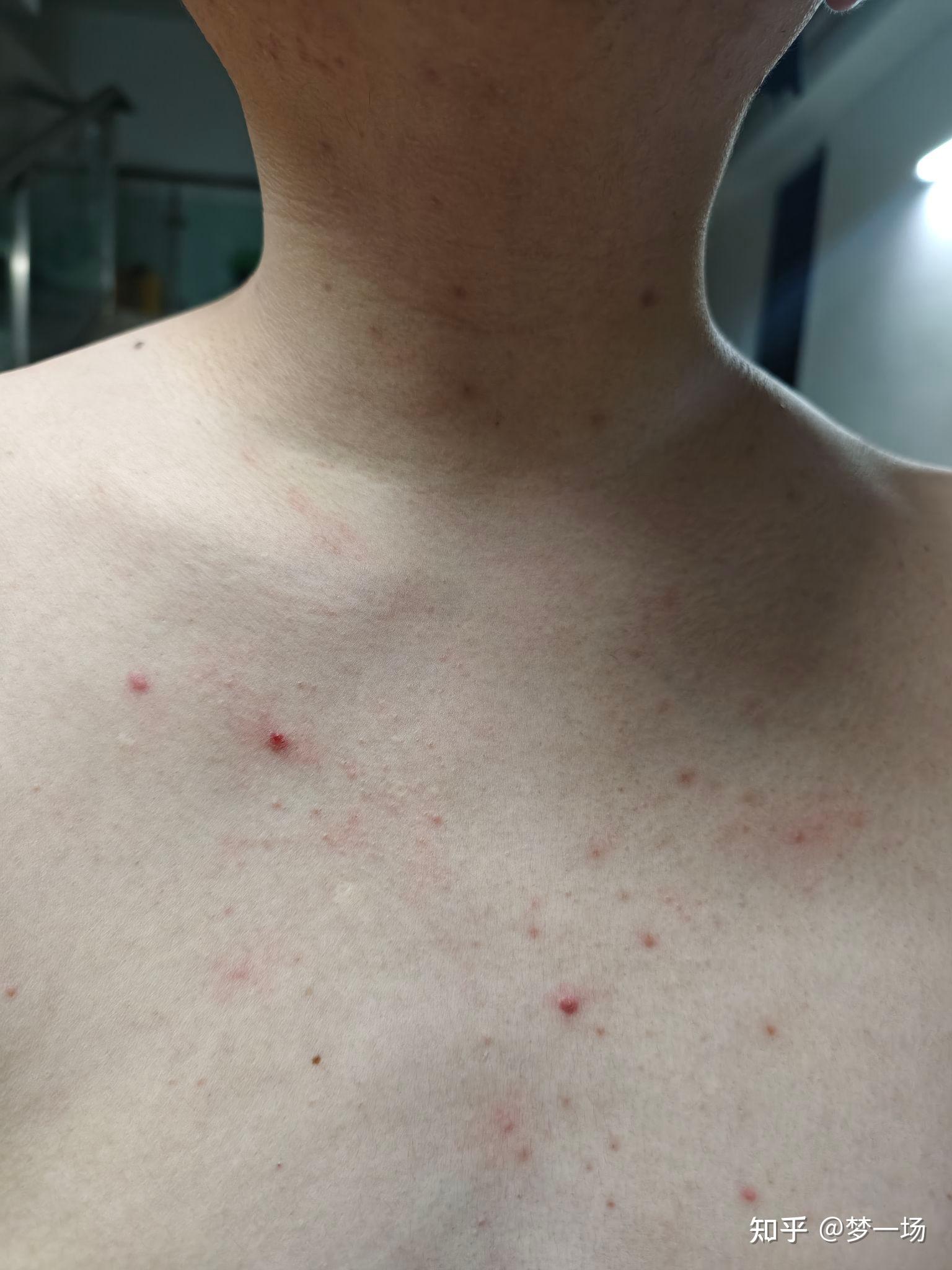 胸前有一小块红疹,是hiv感染吗?