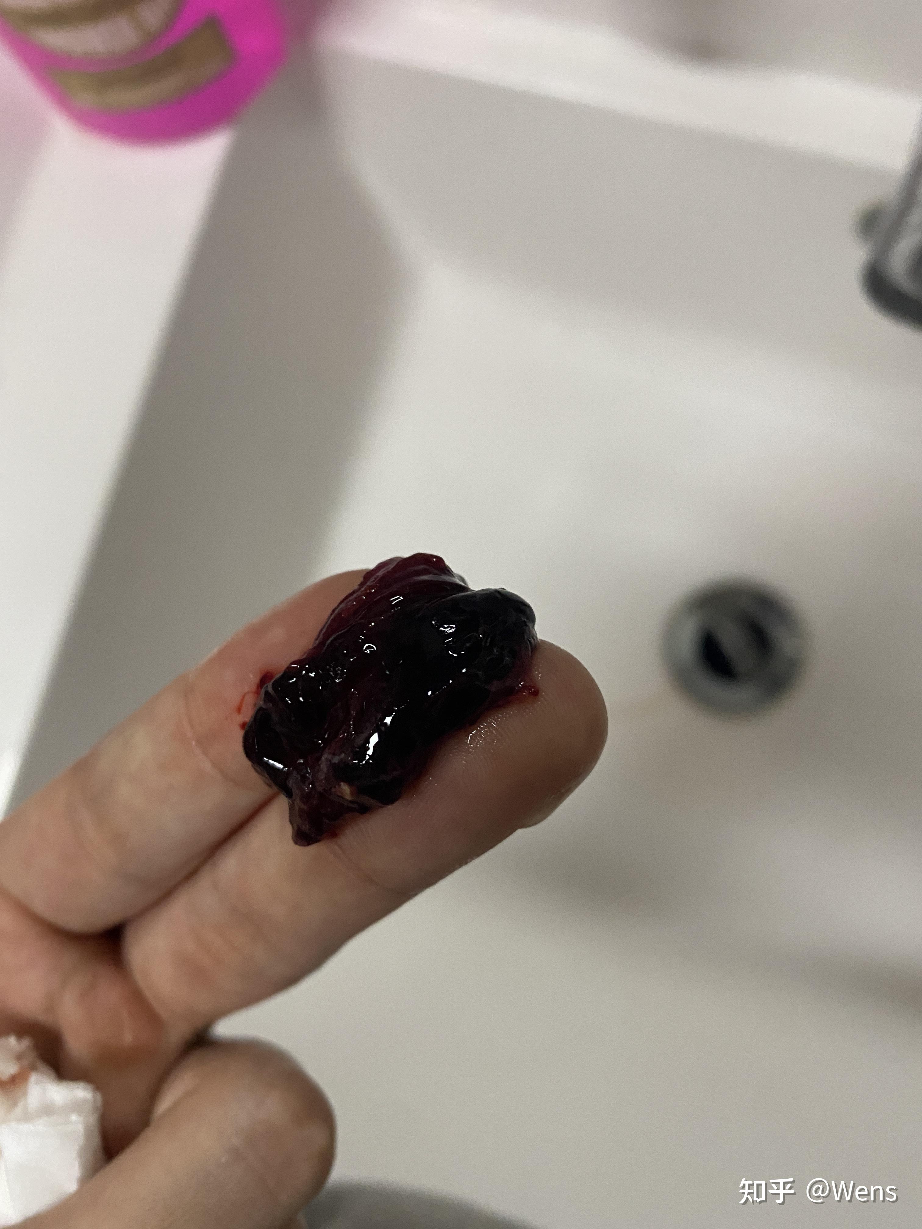 拔牙后血凝块特别大要去医院吗?