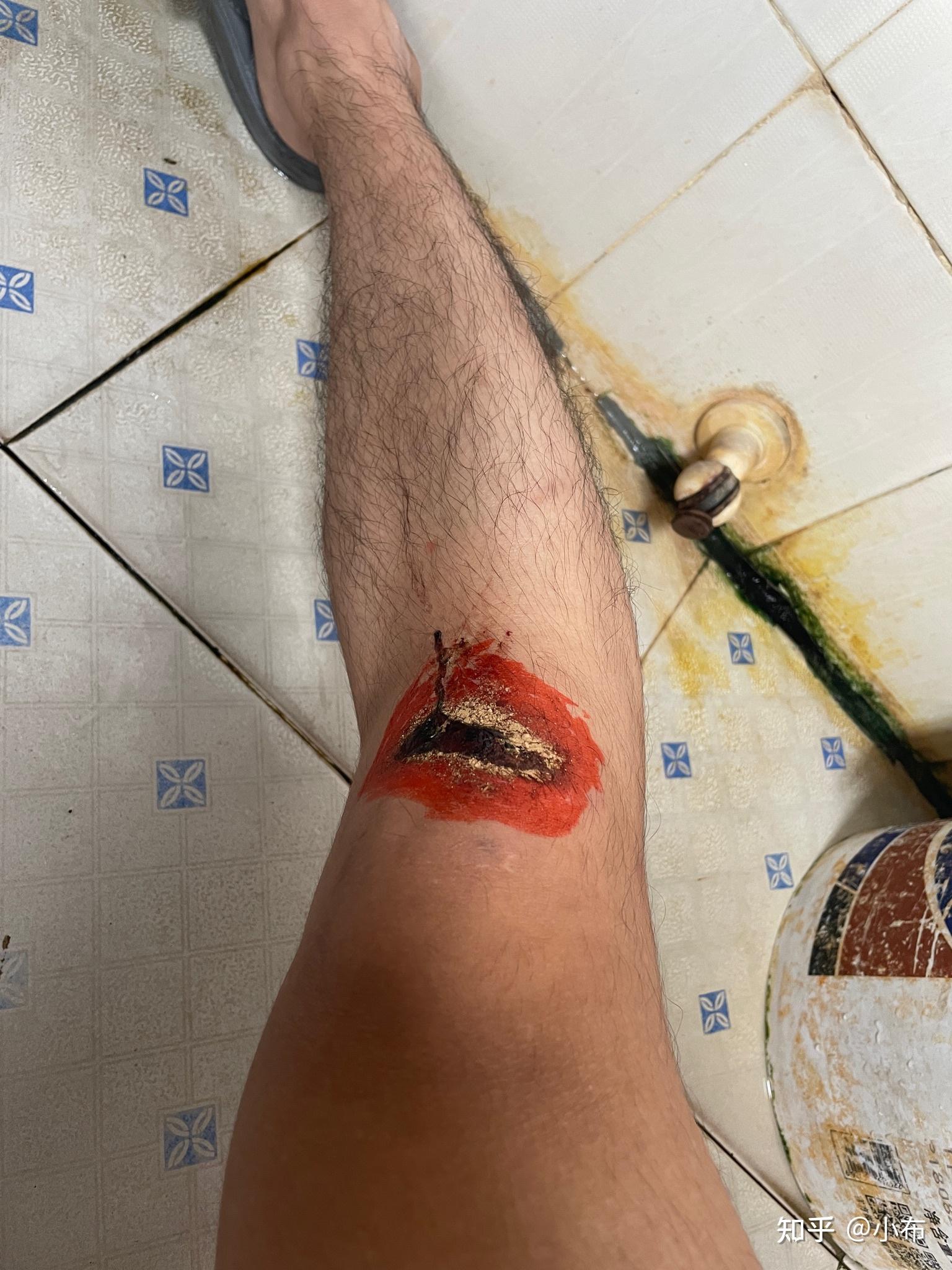 膝盖磕伤了怎么上厕所