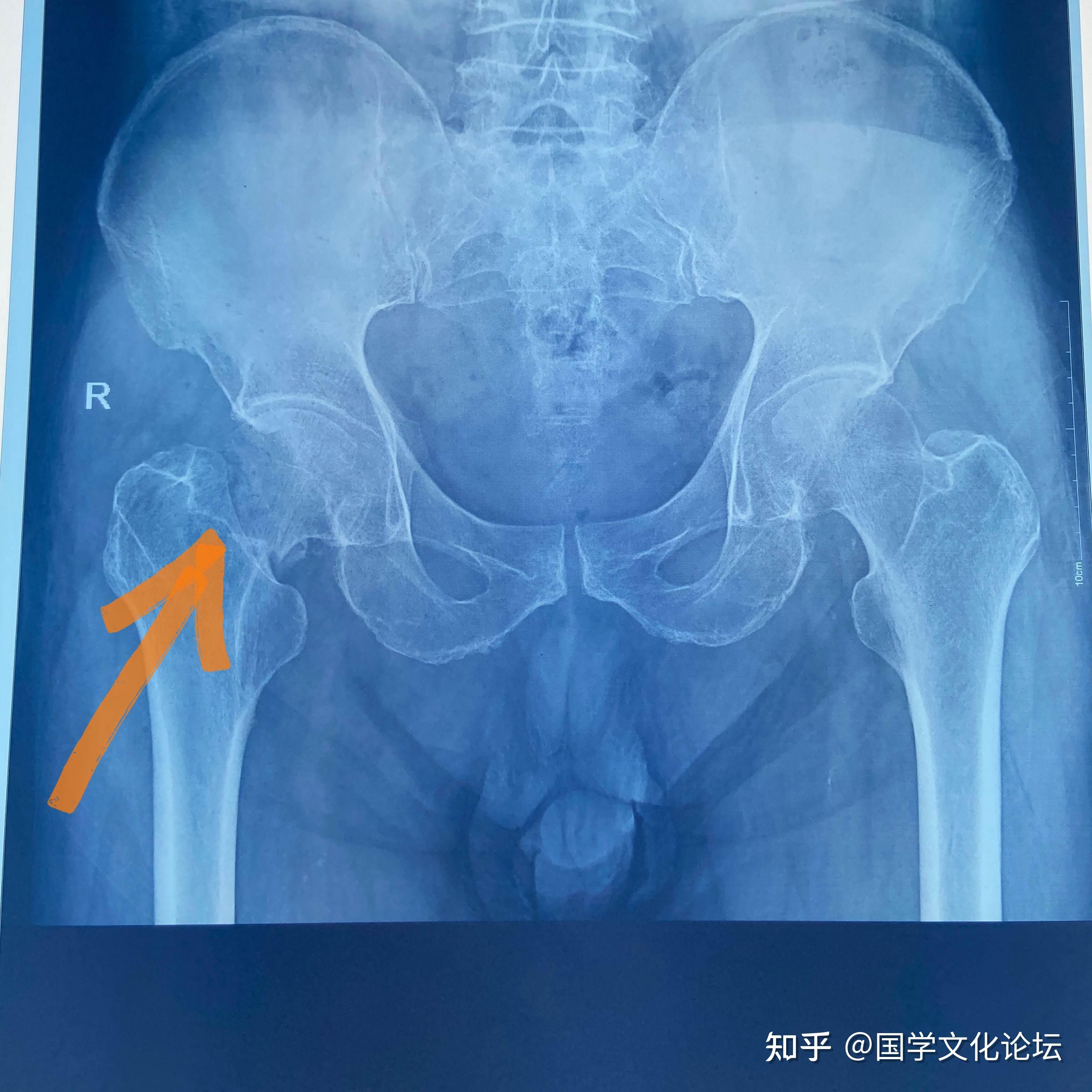 股骨劲骨折图片?