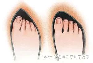 拇外翻(拇囊炎)物理治疗指南 - 知乎