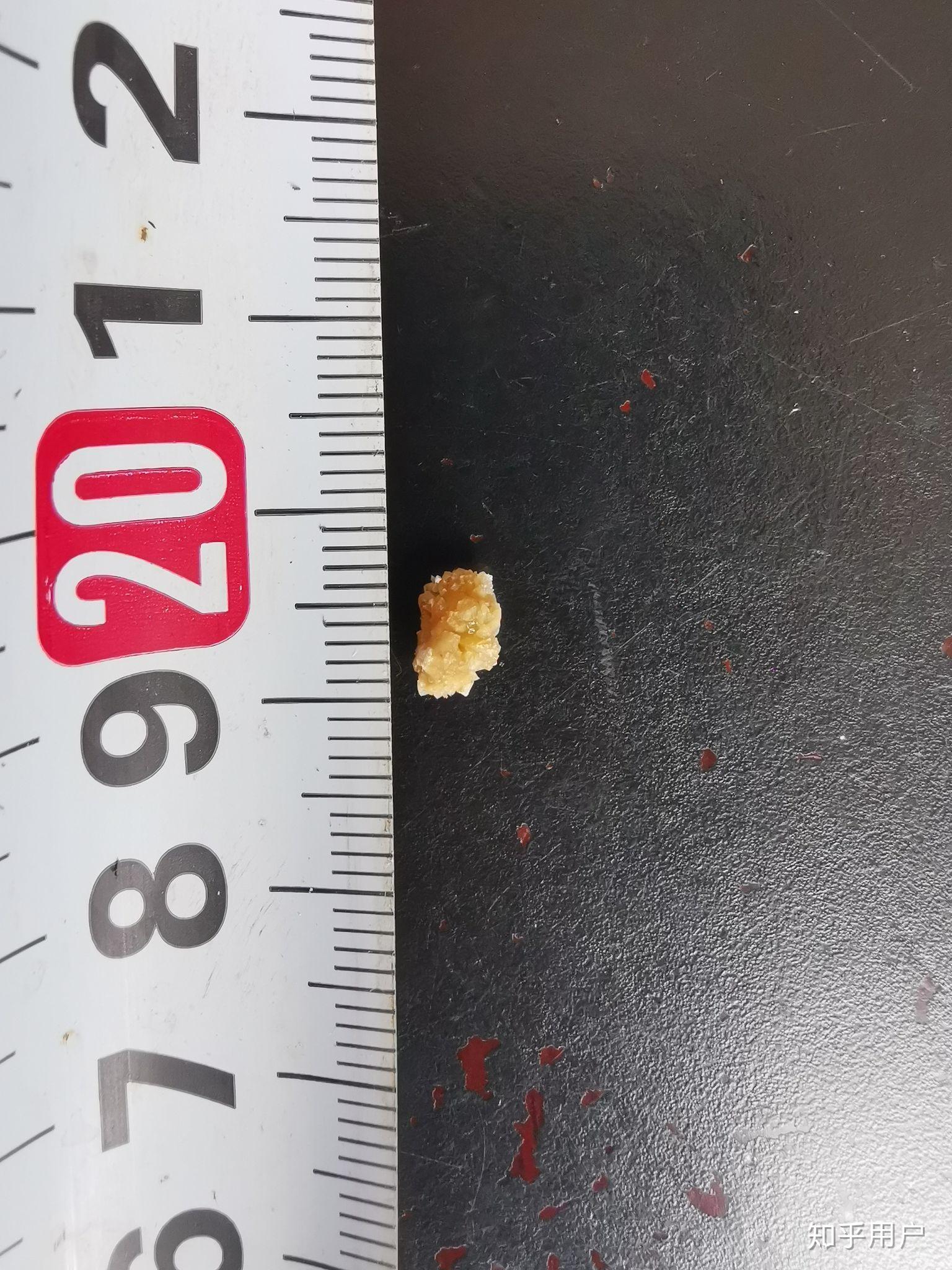 7毫米肾结石图片图片