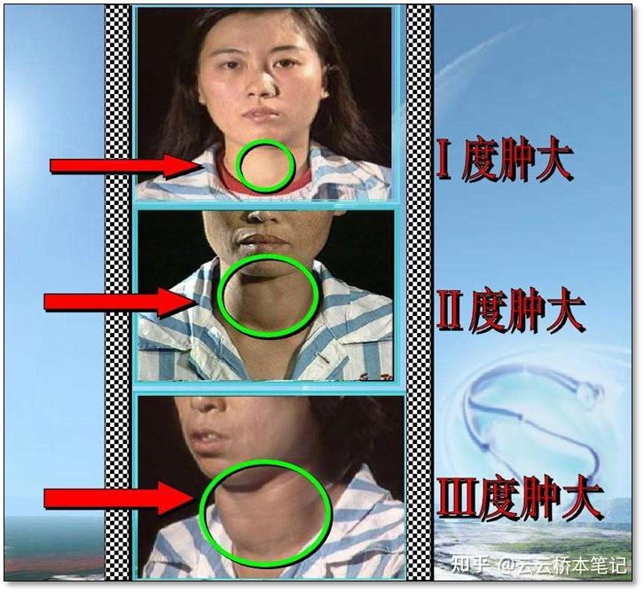 甲状腺结节 桥本甲亢需要手术吗? - 知乎