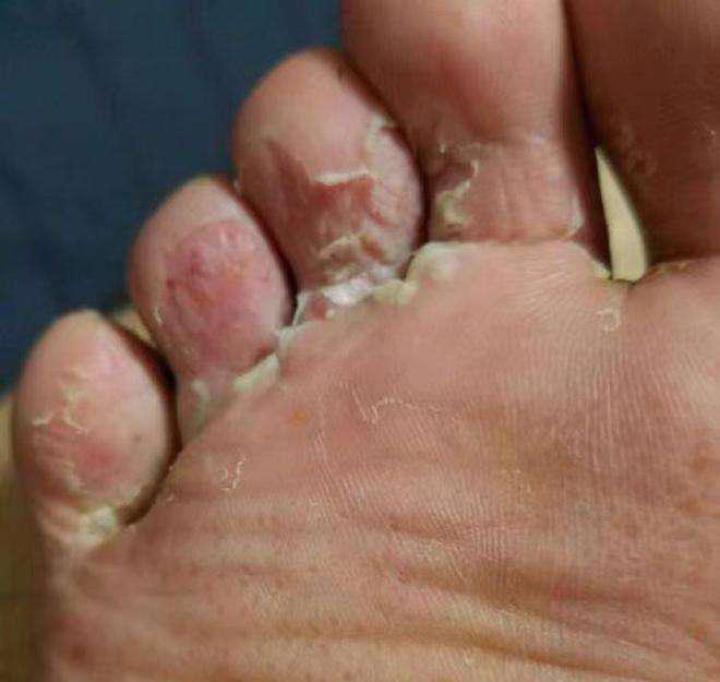 脚趾得水泡脚气,水泡应该弄破吗? - 知乎