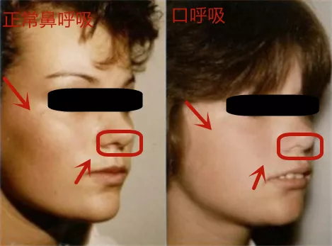 口呼吸是怎么让你变丑的