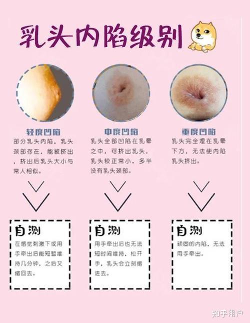 乳头 正常 发育图片