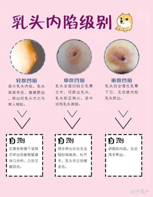 21岁女生没有乳头,不是乳头内陷,不是乳头短平,就像小女生那种刚发育
