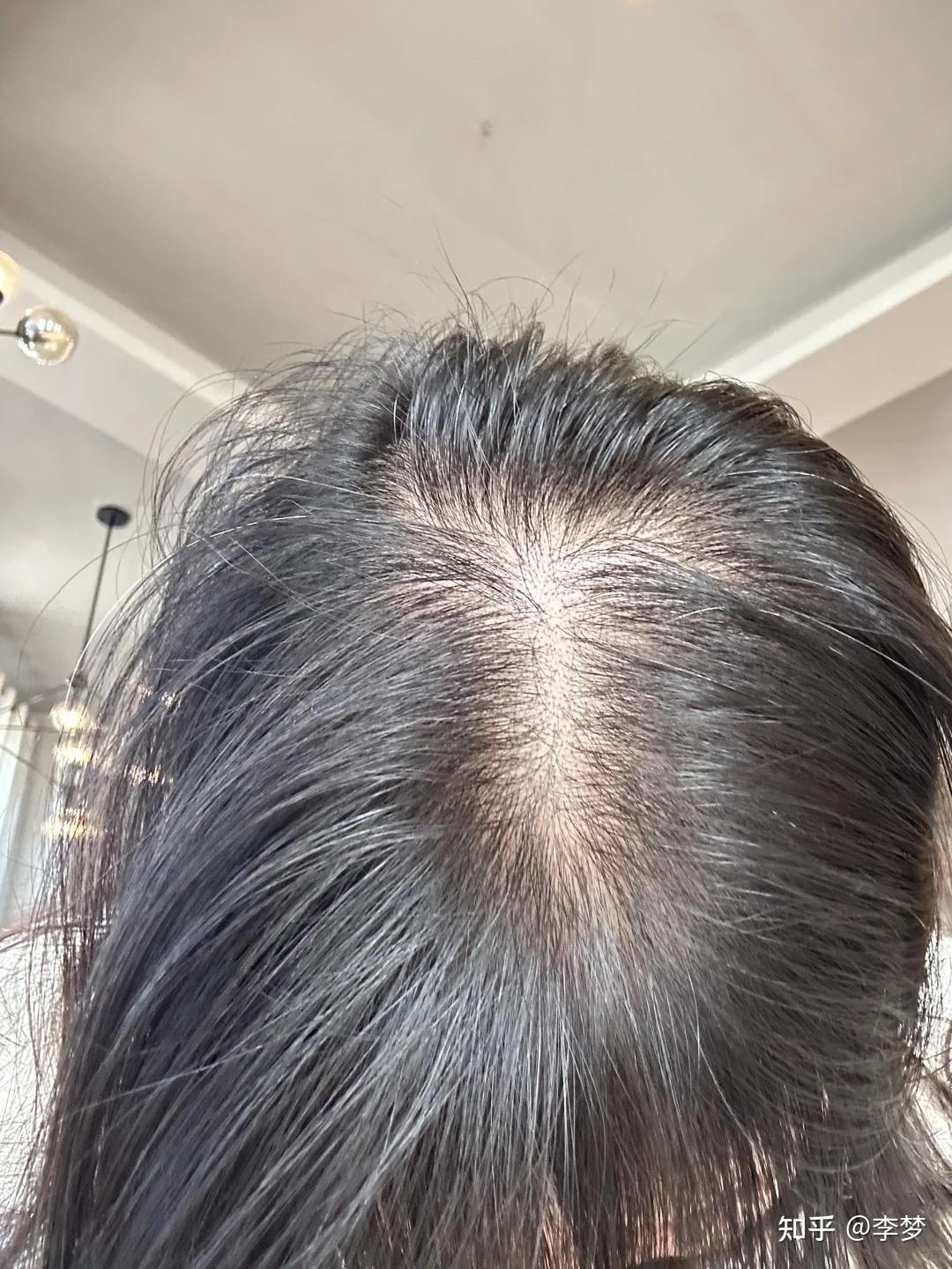 时隔十年!中国雄激素秃发诊疗指南发布:预防防脱首选侧柏叶