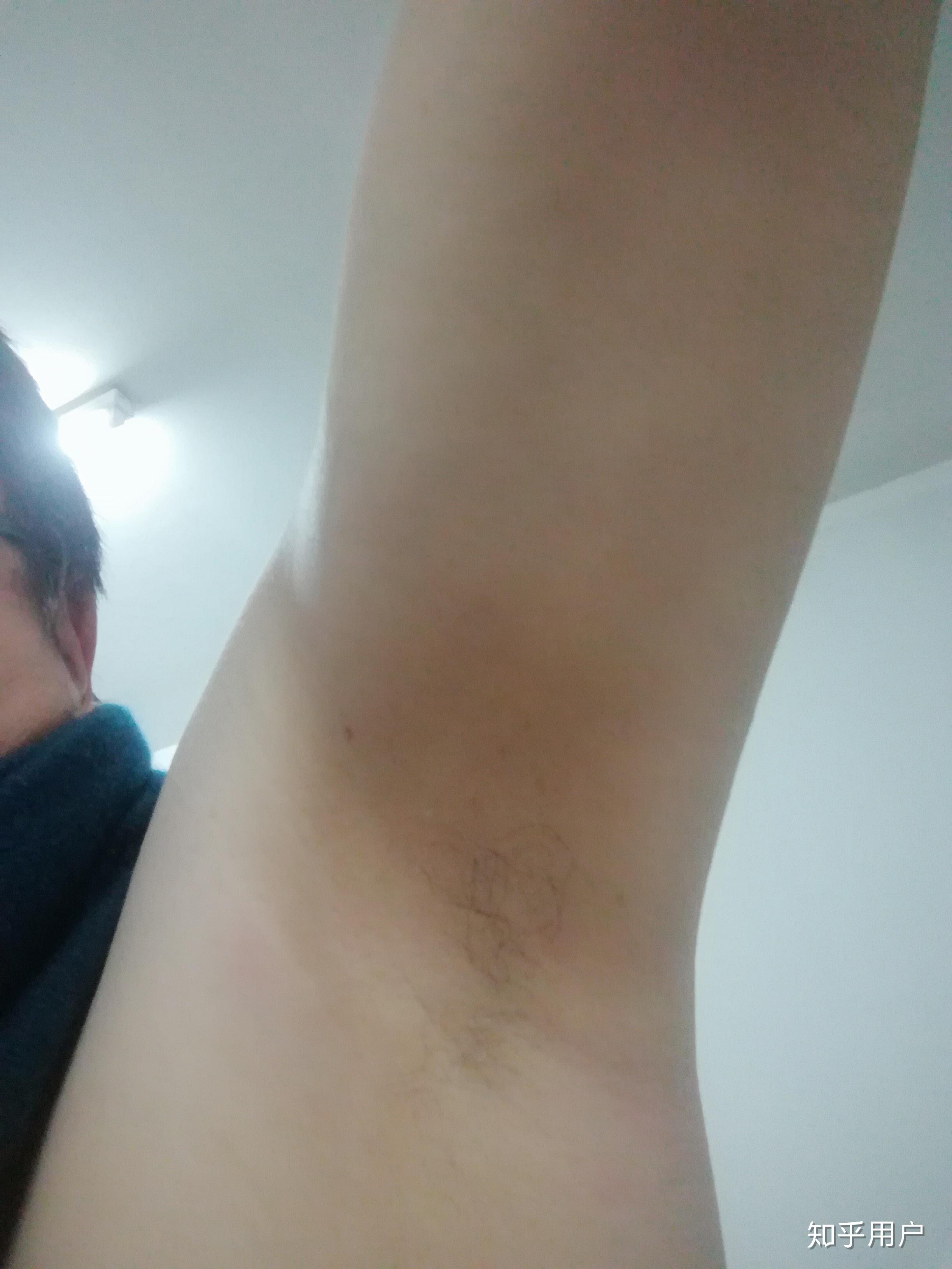 25岁男,腋毛稀少? - 知乎