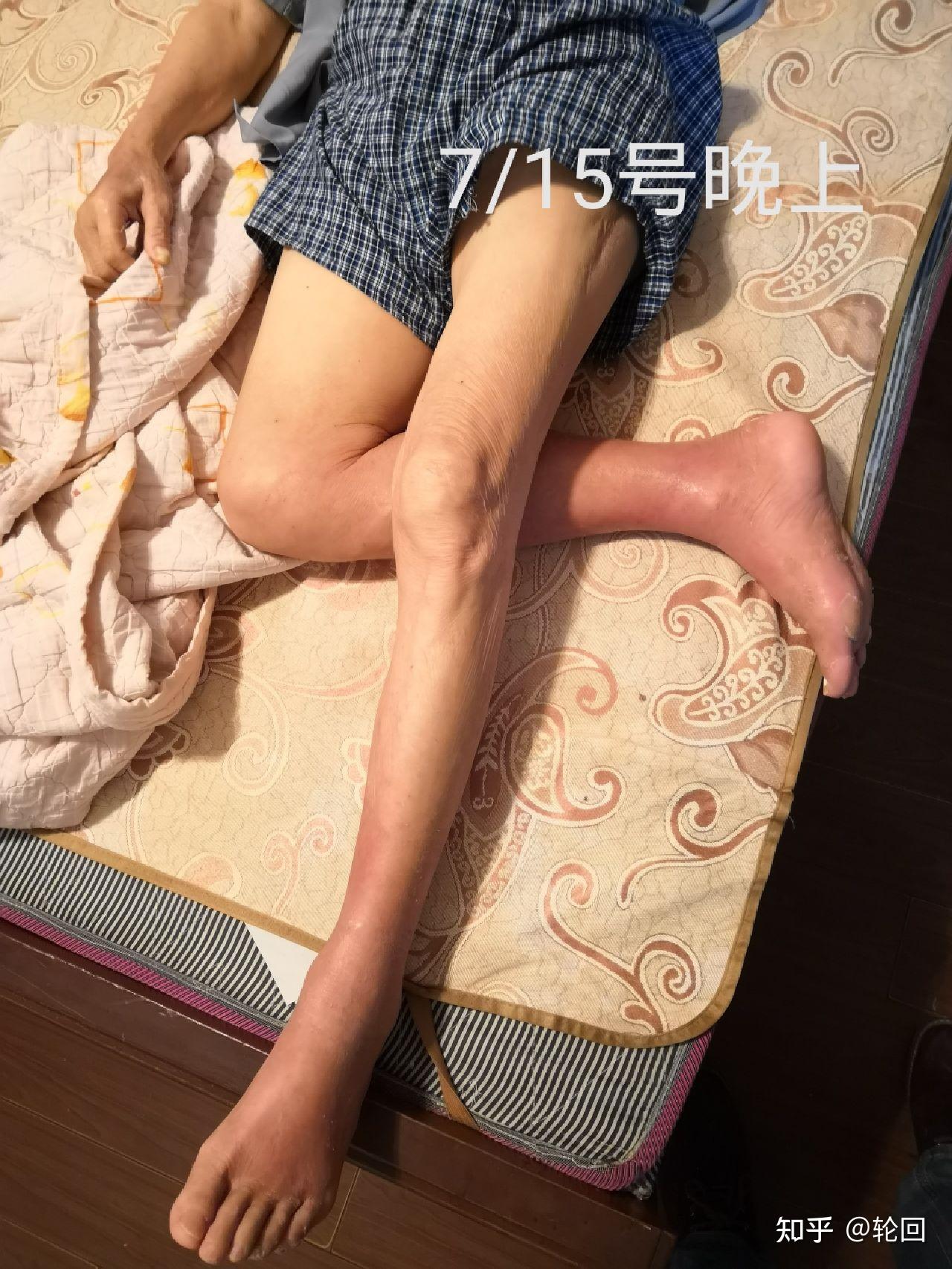 72岁老人小腿骨折，1个月能下地走路，医生称赞：做对2件事！_凤凰网视频_凤凰网