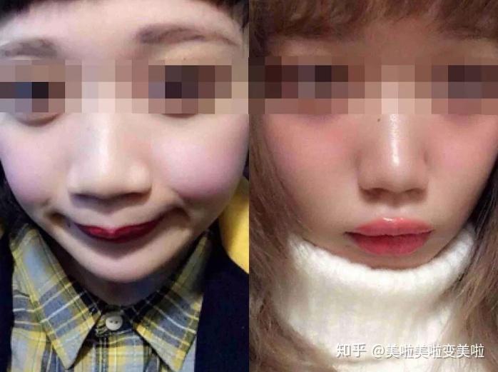 我想缩小鼻翼适合内切还是外切