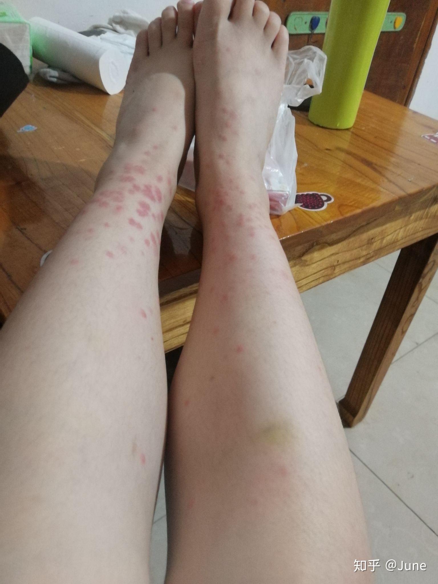 被跳蚤咬的全身都是包是什么样的感受