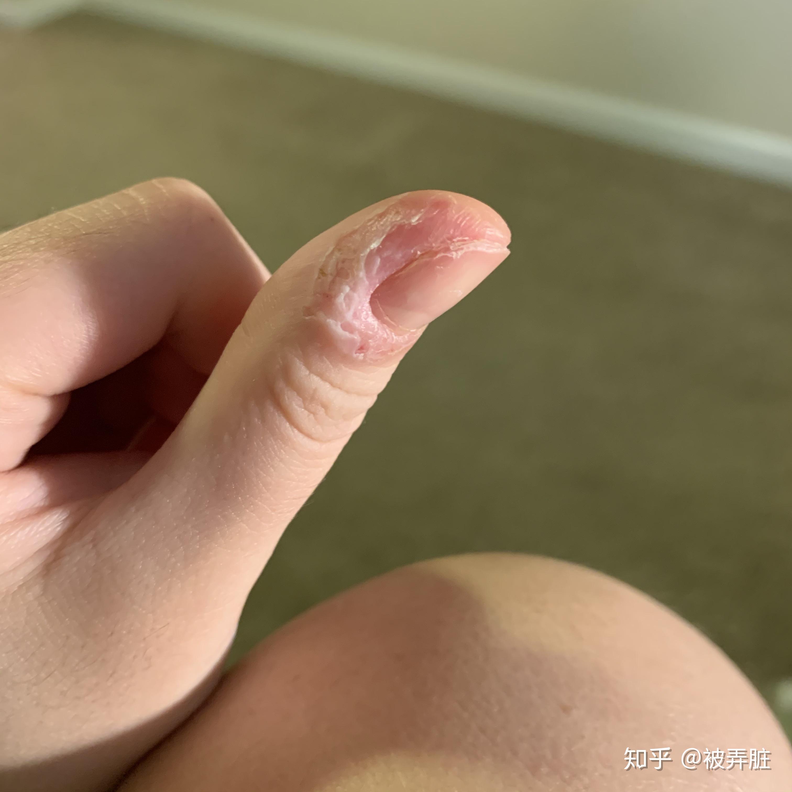 小孩抠手指甲烂手图图片