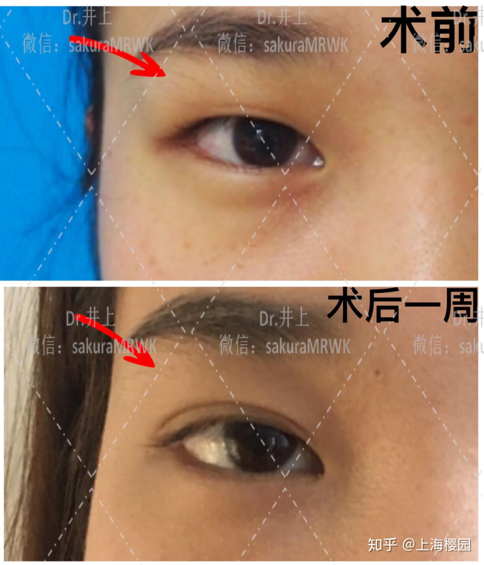 如图肿眼泡上眼皮厚眼球突出╥﹏╥该怎么整推荐比较好的整形医院