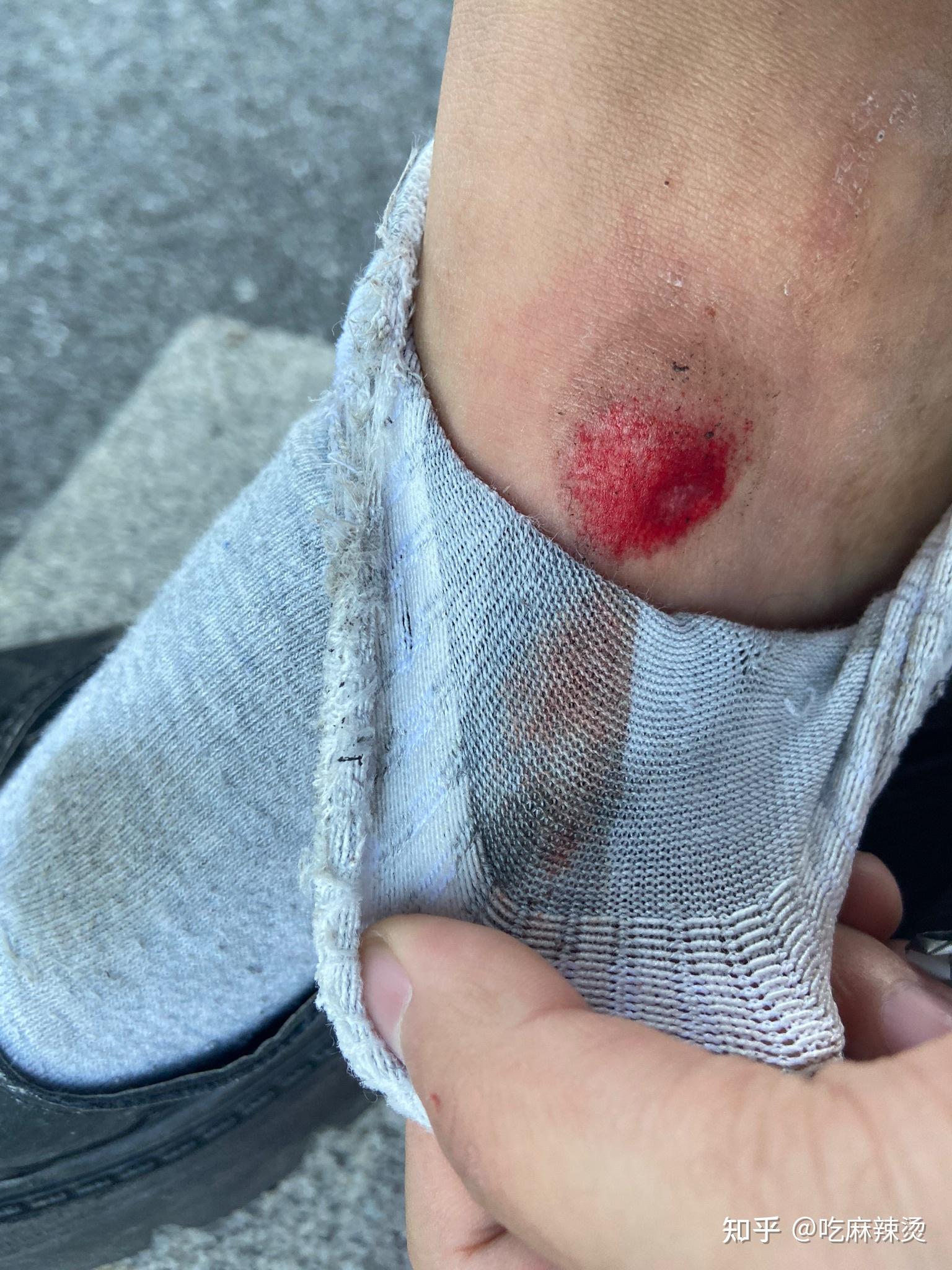 膝盖摔伤破了一大块皮流水抹云南白药好了一点三天后开始流水了咋办呢