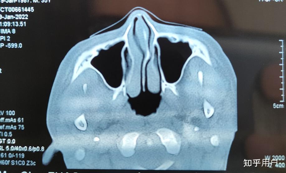 鼻中隔偏曲手术是一种怎样的体验?