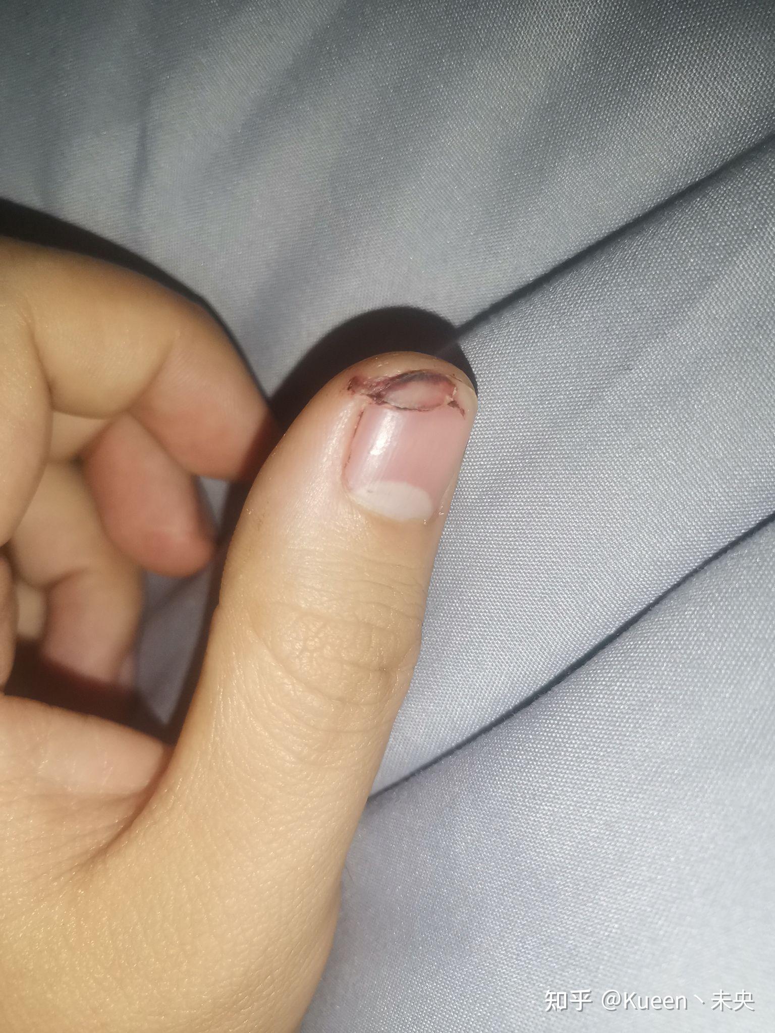 指甲从中间断了 怎么快速愈合? - 知乎