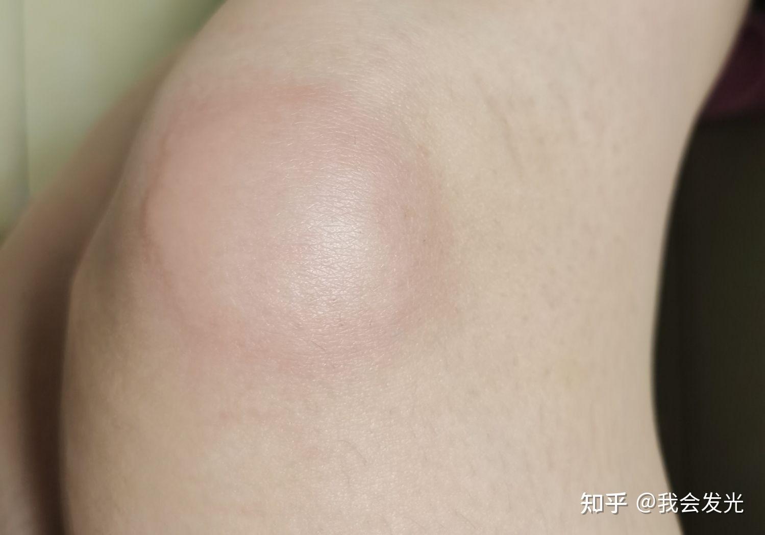 为什么蚊子咬完会肿起来一大片硬包还很热周围皮肤是凉的是我的免疫